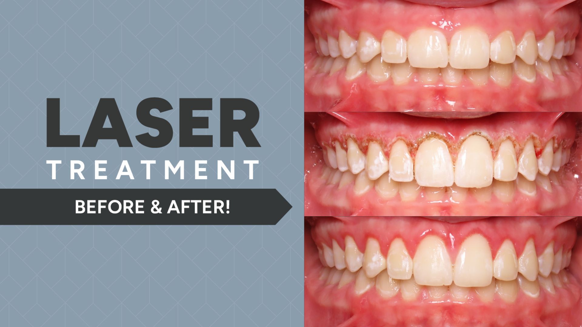 AOG-AydenLaserb4andafter1