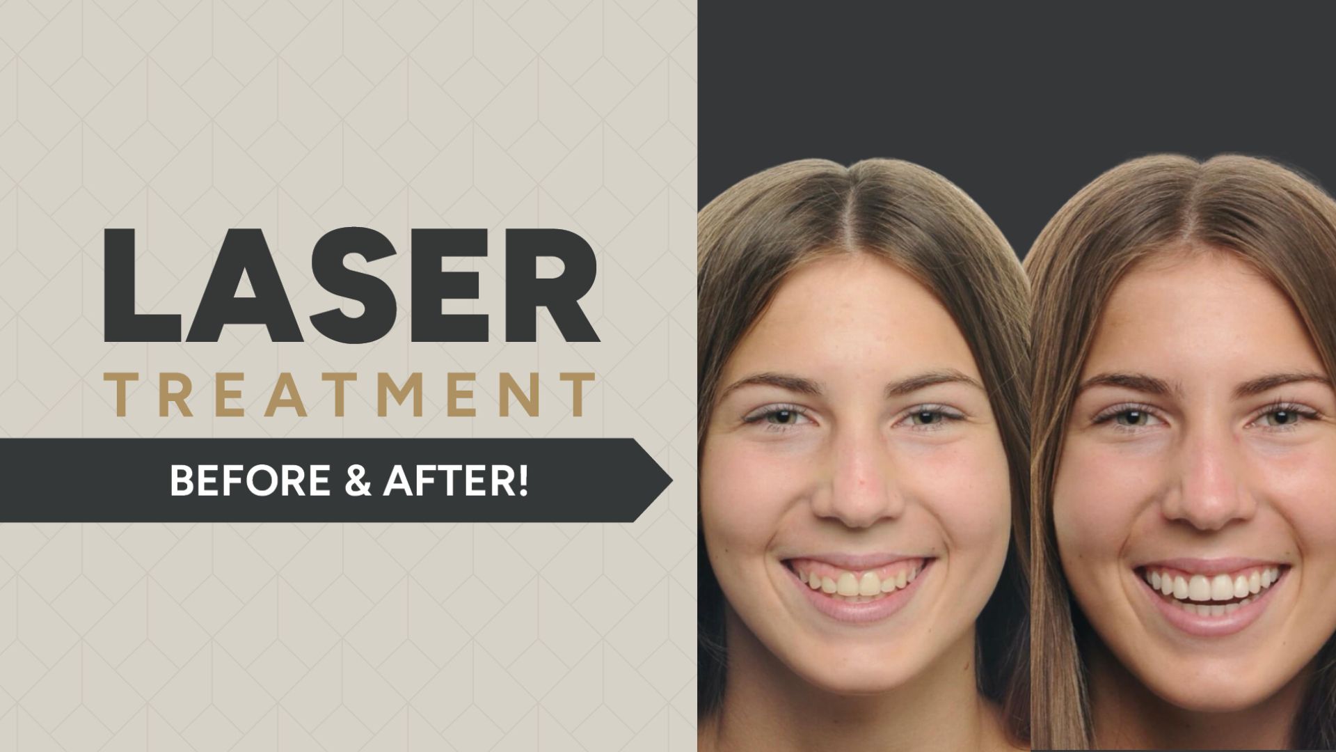 AOG-SamplelaserPt