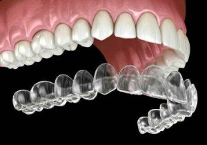 Best Braces Services in Gilbert