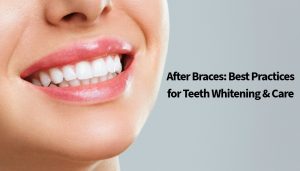 Teeth Whitening
