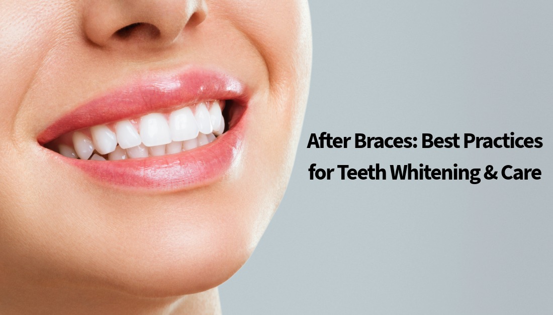 Teeth Whitening