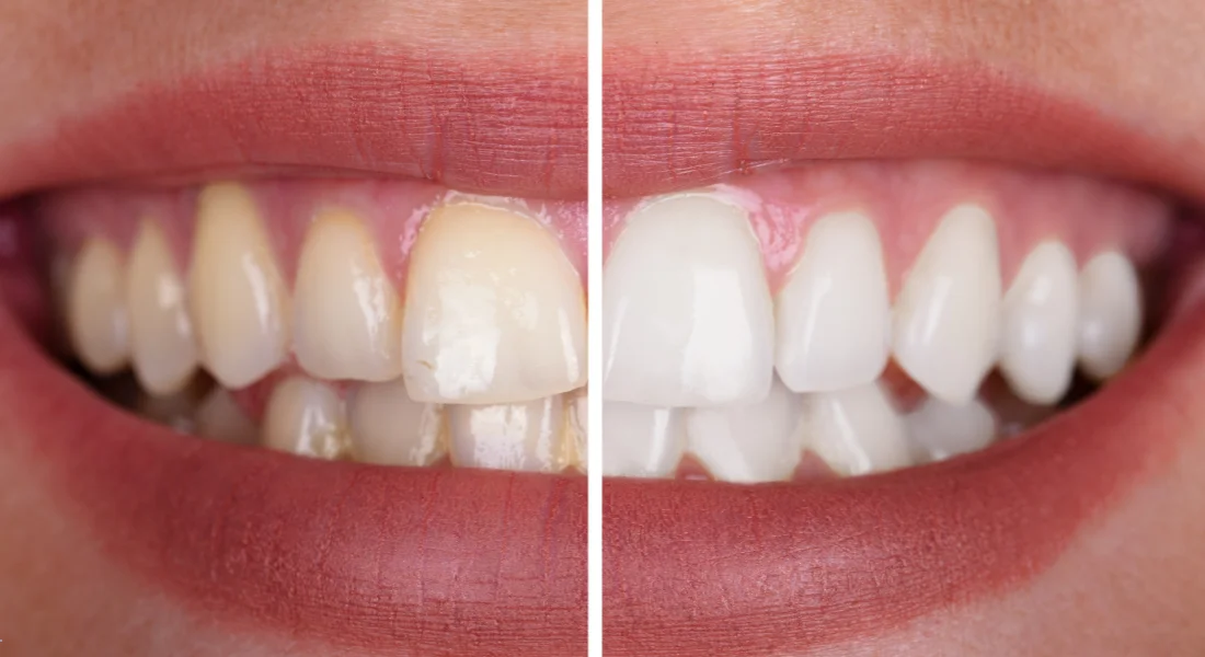 Best Way To Whiten Teeth