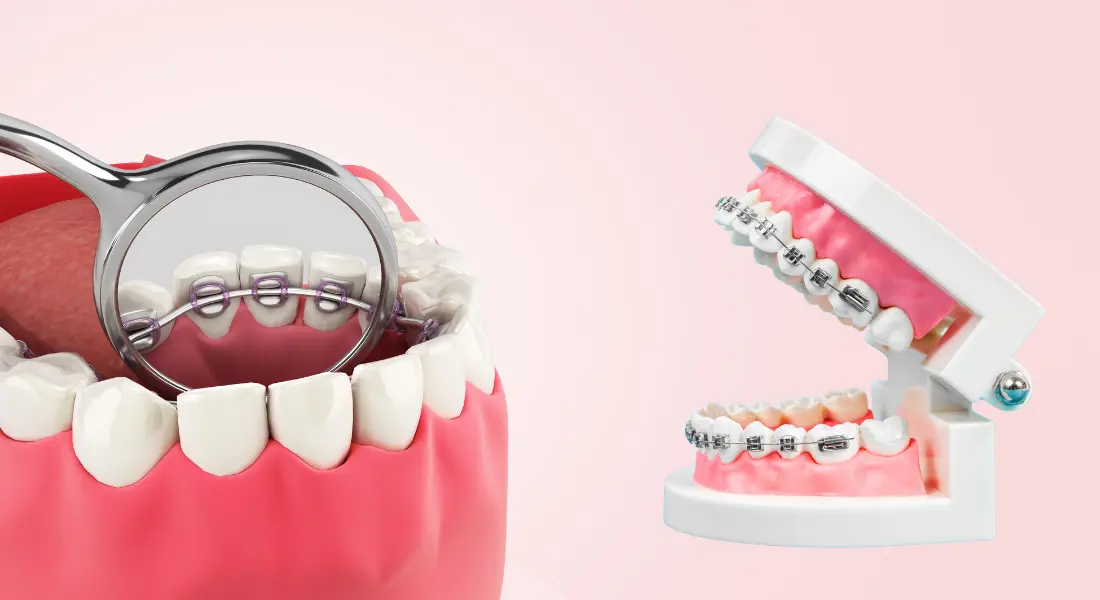 Braces vs Lingual Braces Cost (1)