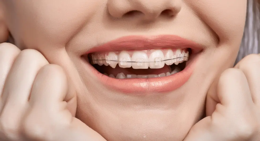 Braces vs Lingual Braces Cost
