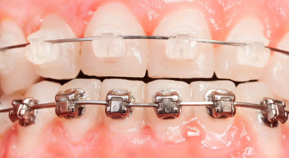 Clear Braces vs Metal