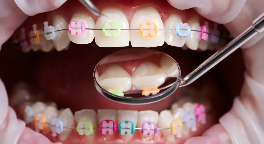 Color Braces for Teeth