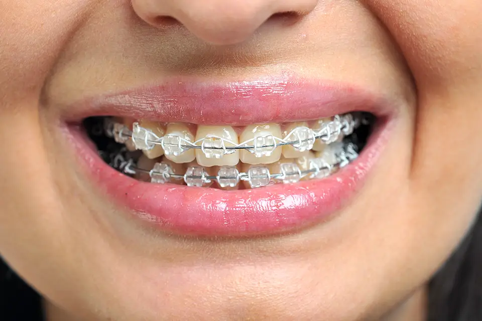 clear braces for adults