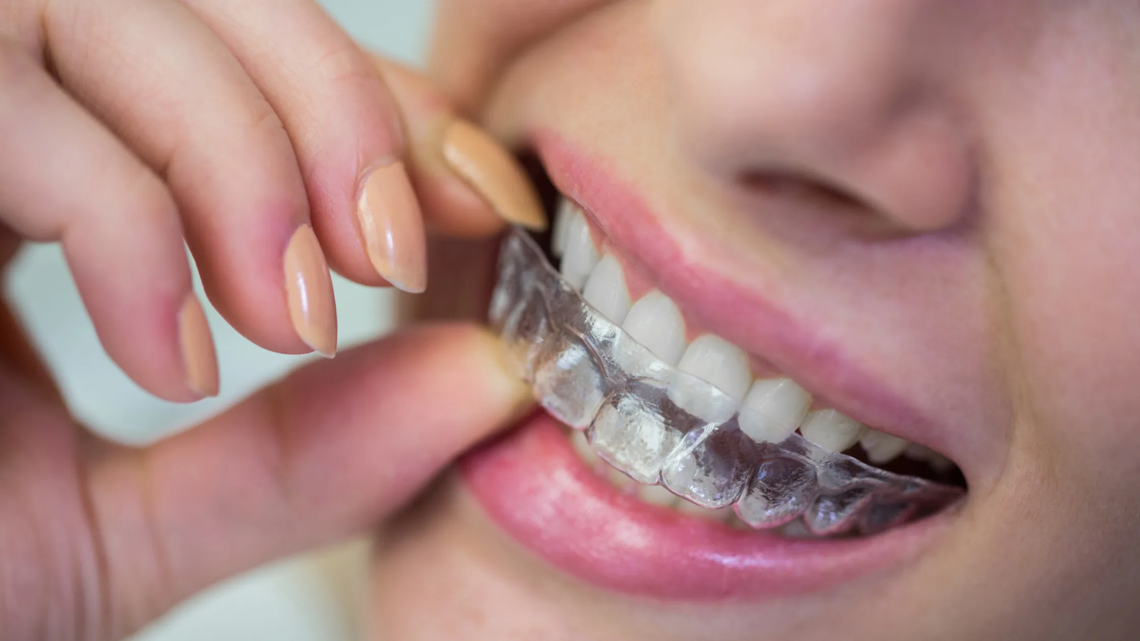Is a Retainer necessary after ortho treatment