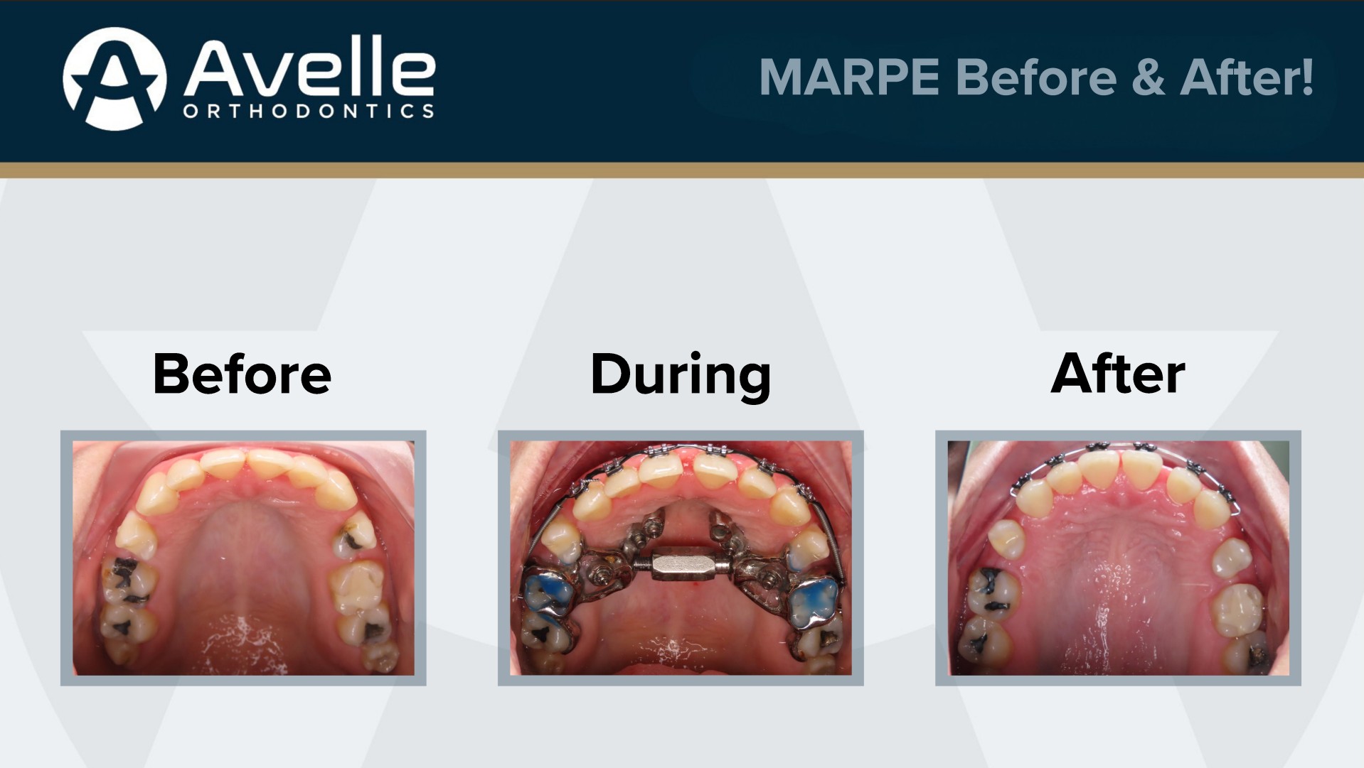 MARPE Before & After 1
