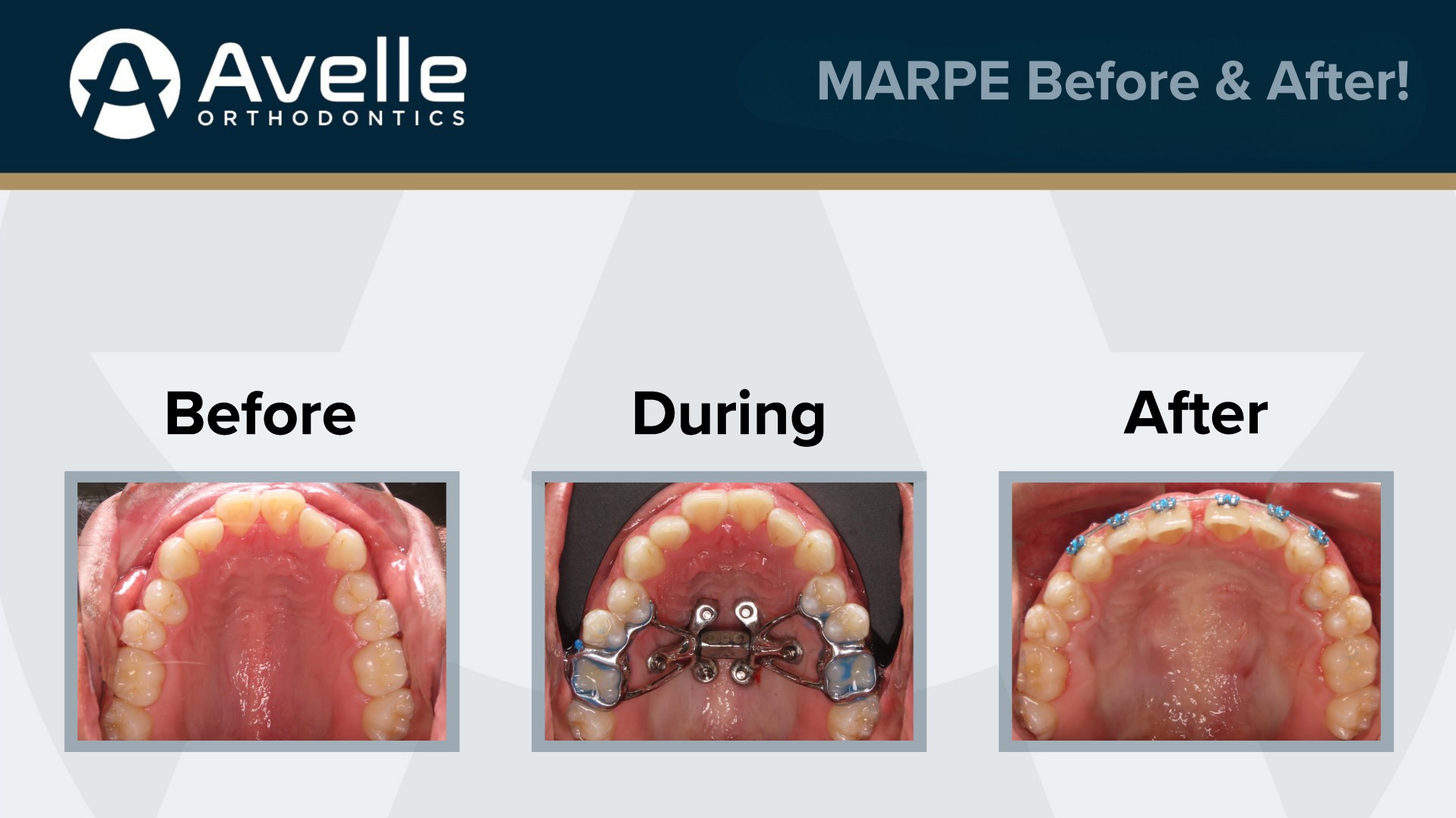 MARPE Before & After 2