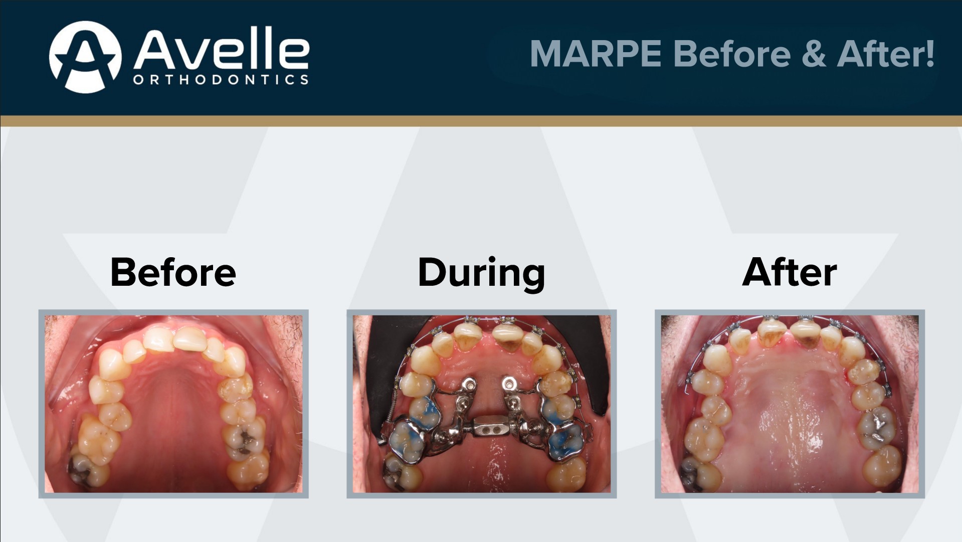 MARPE Before & After 3