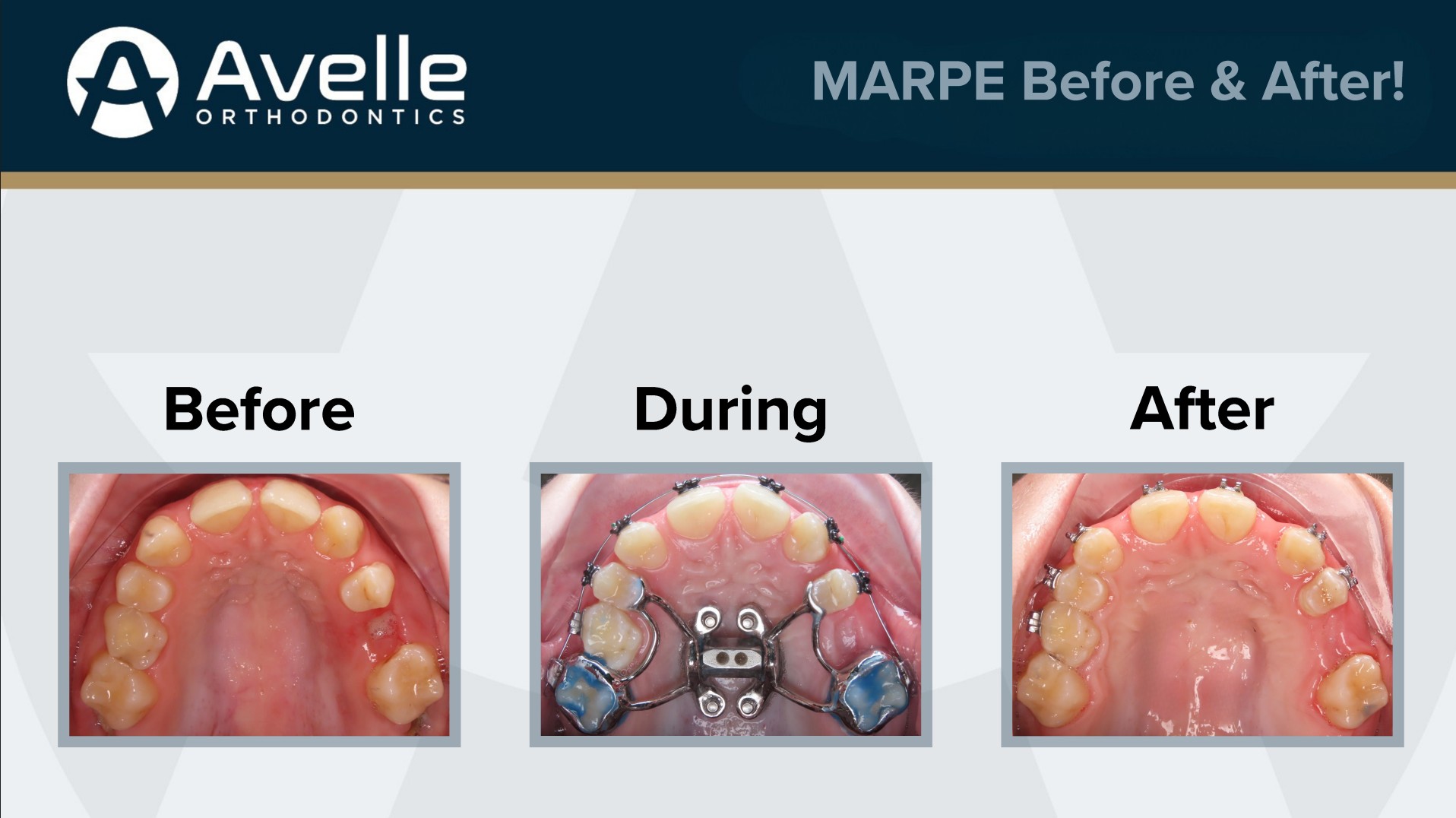 MARPE Before & After 4