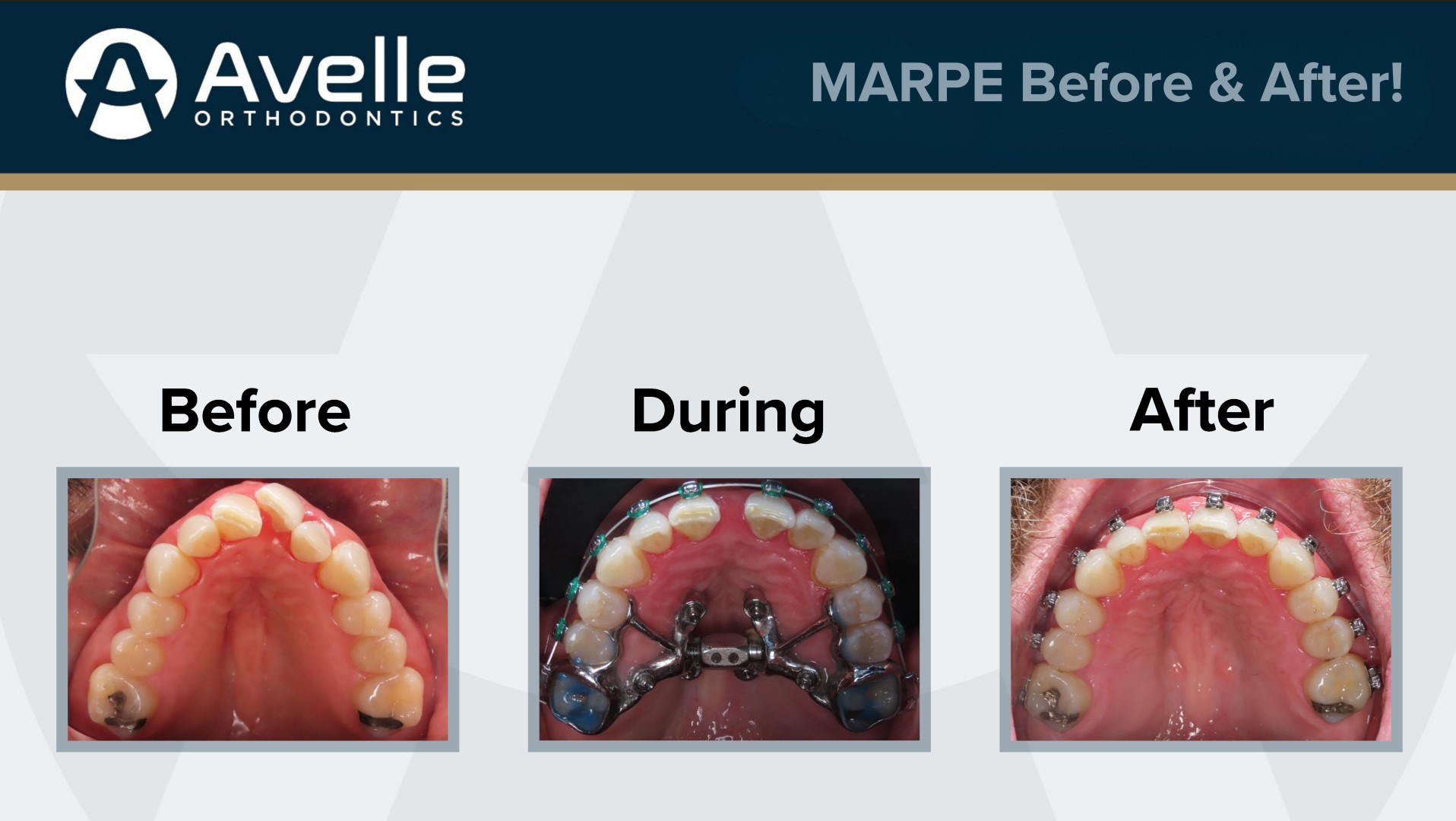 MARPE Before & After 5