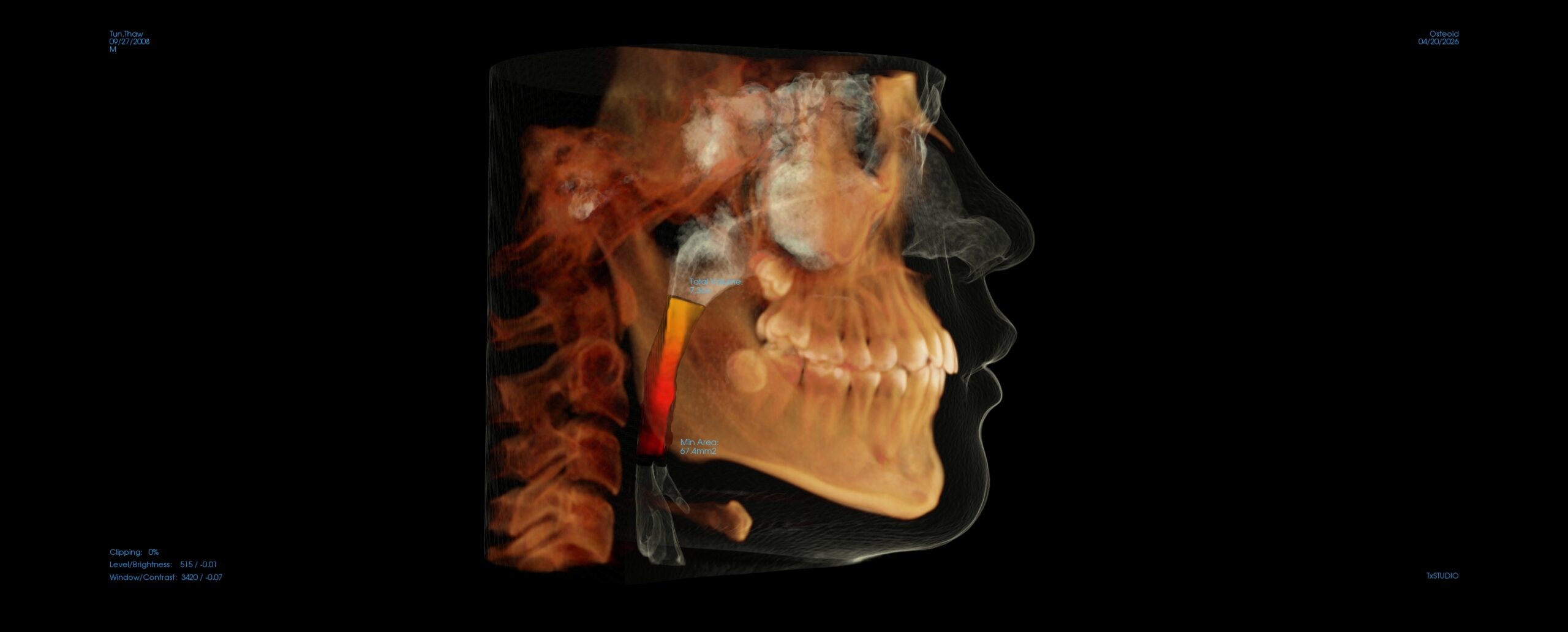 Thaw Tun airway