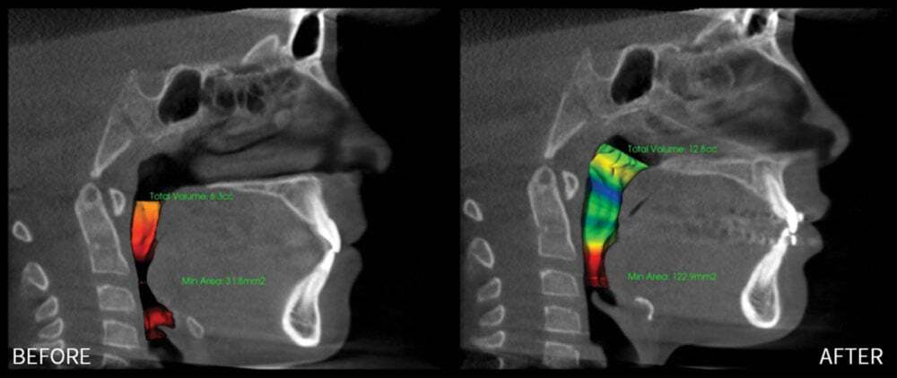 airway xray KID
