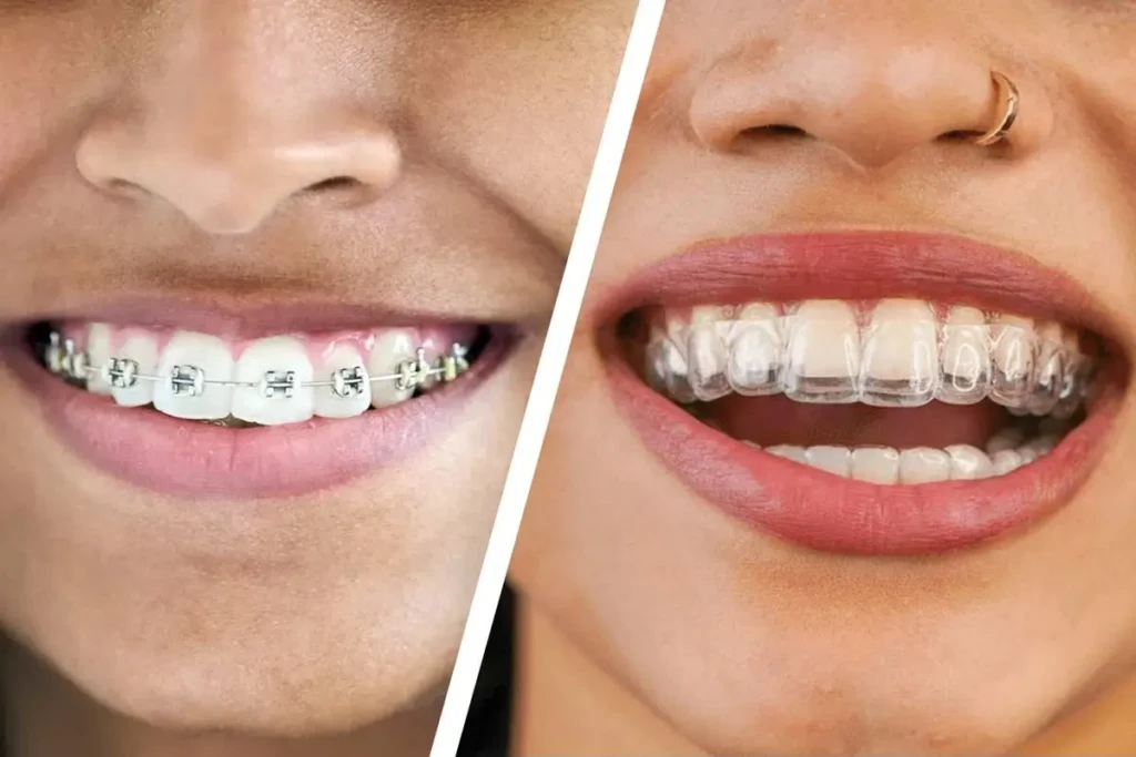 dental braces vs invisalign