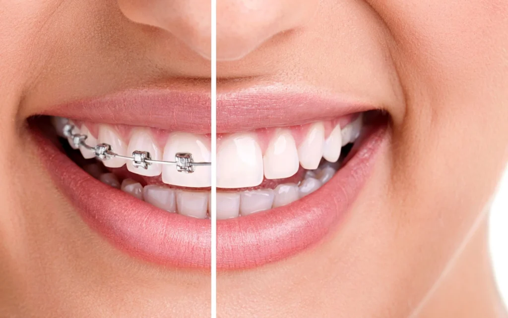 how invisalign works compared to braces 5783135