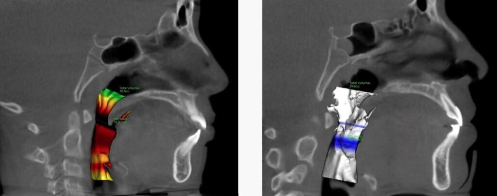 new pre and post airway ADULT