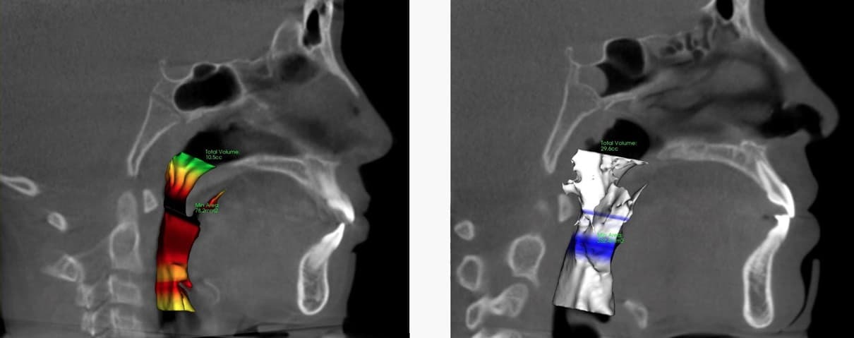new pre and post airway ADULT